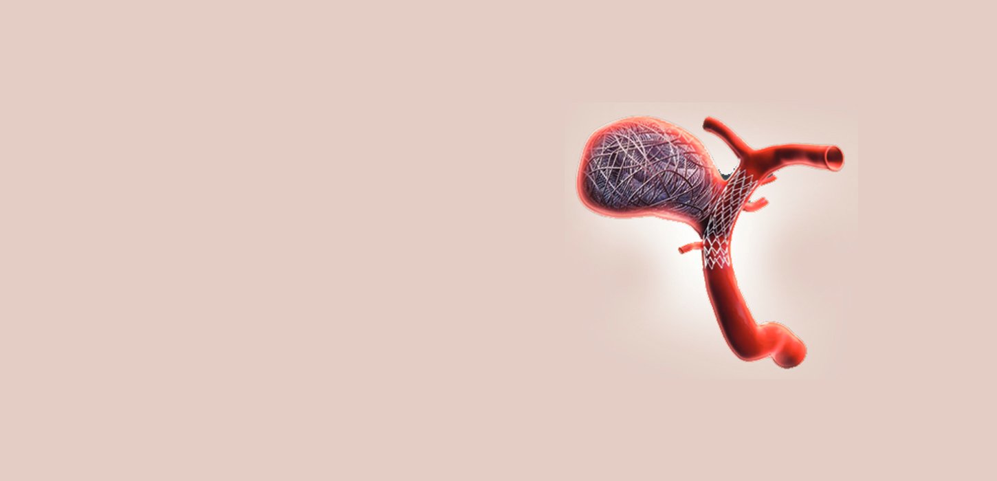 Intracranial Aneurysm Coiling